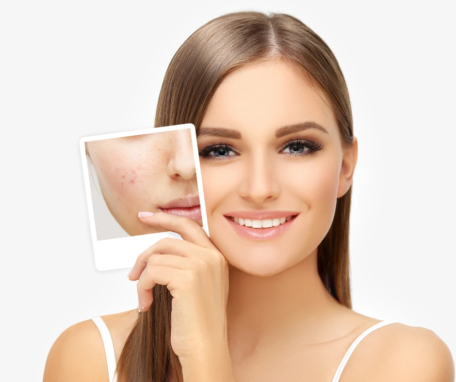 Female With Female With Clear Skin Holding Up an Image of Her Cheek Before Acne Scar Treatment